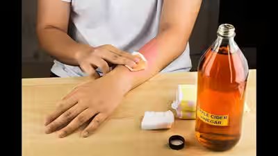 Is it safe to remove moles with apple cider vinegar? Is it safe to remove moles with apple cider vinegar?
