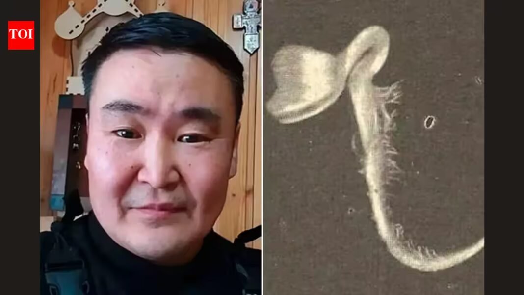 A 42-year-old Russian man suffers months of agonising headaches after a seed sprouts inside his eye following a branch injury during a summer trip | A 42-year-old Russian man suffers months of agonising headaches after a seed sprouts inside his eye following a branch injury during a summer trip |
